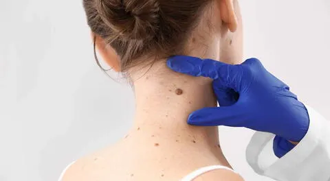 Si tienes un lunar que cambia de color, tamaño o forma, acude a un médico.